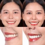 Porcelain veneer before and after results at SmileBox Dental Clinic - Thonglor, Sukhumvit Branch