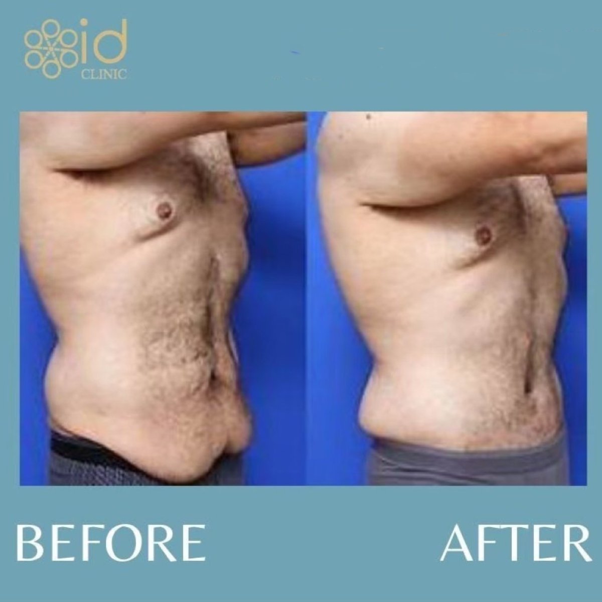 نتائج قبل وبعد فيزر 3 مناطق مع شد البطن في ID Clinic Bangkok، نحت الجسم