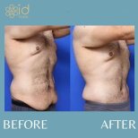Before and after Vaser 3 areas plus tummy tuck results at ID Clinic Bangkok, body contouring