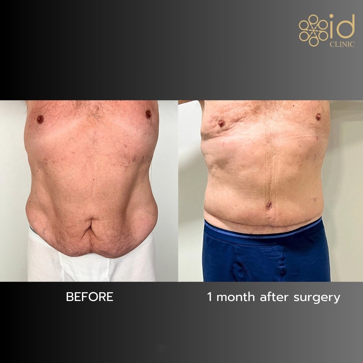 Resultados antes y después de Vaser 3 áreas más abdominoplastia en ID Clinic Bangkok