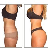 Vorher-nachher-Ergebnis Po-Lifting bei ID Clinic Bangkok, verbesserte Kontur und Volumen