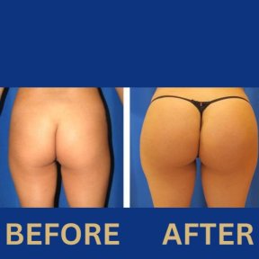 Vorher-nachher-Ergebnis Po-Lifting bei ID Clinic Bangkok, verbesserte Kontur und Festigkeit