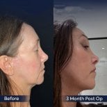 Before and after neck lift results at Dr. Safa Manav Clinic, improved jawline definition