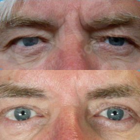 Vorher-nachher-Ergebnis der Blepharoplastik in Adem and Havva Medical Center, Lidkorrektur