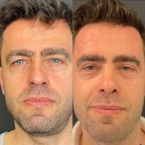 Vorher-nachher-Ergebnisse der Blepharoplastik bei Adem and Havva Medical Center, Lidkorrektur