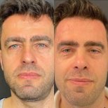 Vorher-nachher-Ergebnisse der Blepharoplastik bei Adem and Havva Medical Center, Lidkorrektur