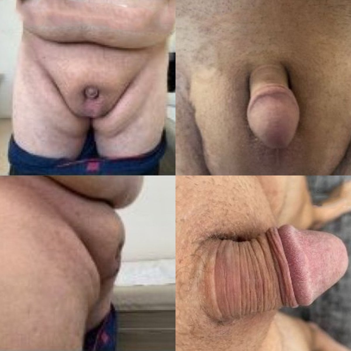 نتائج قبل وبعد جراحة القضيب المدفون في Uroaesthetic، تحسين مظهر الأعضاء التناسلية