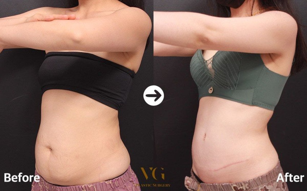 Résultats avant et après liposuccion chez VG Plastic Surgery, amélioration visible du ventre