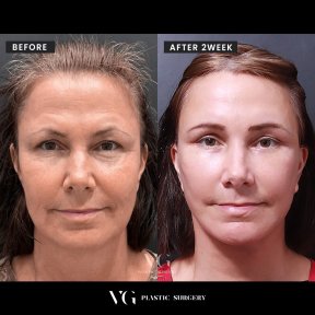 Vorher-nachher-Ergebnis Oberlidstraffung bei VG Plastic Surgery, sichtbare Verjüngung