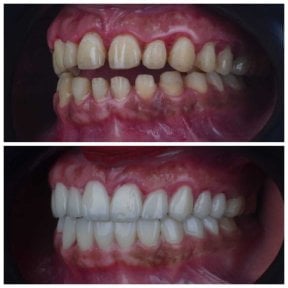 Resultados antes y después de coronas de zirconio en Omara Dental Centers, cambio de sonrisa