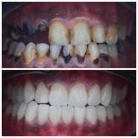 Resultados antes y después de coronas de zirconia en Omara Dental Centers, restauración de sonrisa