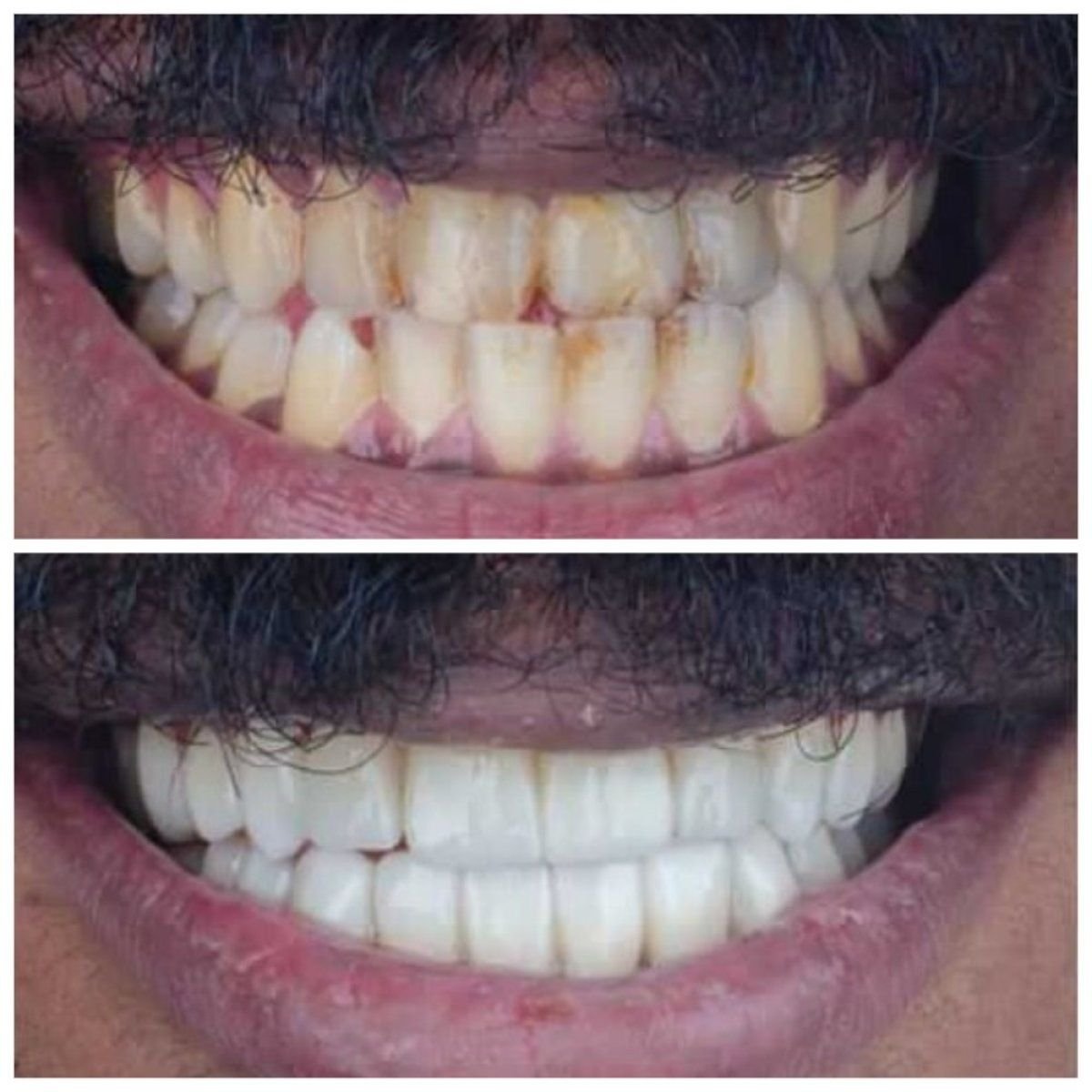 Before and after zirconia crown results at Omara Dental Centers, smile restoration procedure
