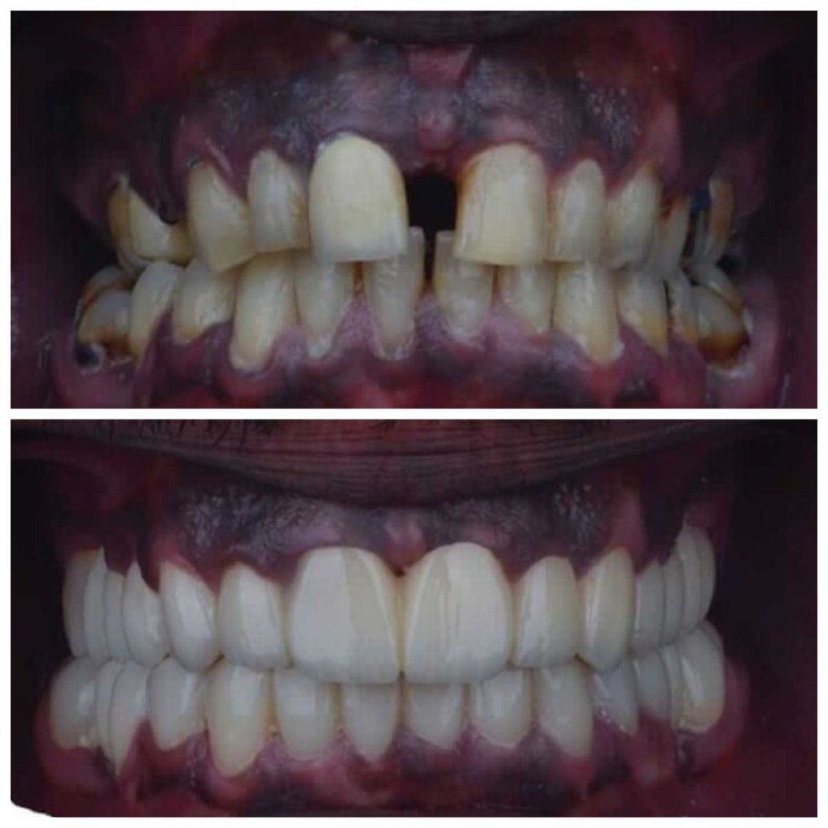 Before and after zirconia crown installation results at Omara Dental Centers, smile restoration