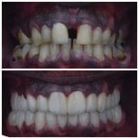 Resultados antes y después de coronas de zirconia en Omara Dental Centers, restauración de sonrisa