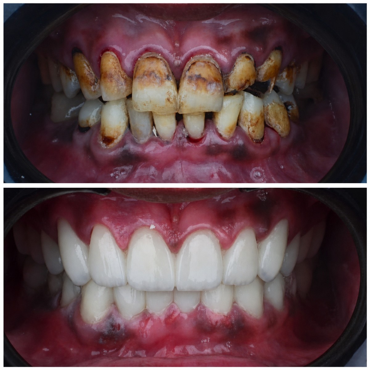 Antes y después de carillas Emax en Omara Dental Centers: resultado de transformación de sonrisa