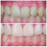 Vorher-nachher-Ergebnis Emax-Veneers bei Omara Dental Centers, Lächeln-Transformation