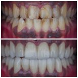 Vorher-nachher Emax Veneers bei Omara Dental Centers – natürliches Lächel-Makeover