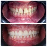 Vorher-nachher Emax Veneers bei Omara Dental Centers – natürliches Lächeln Ergebnis