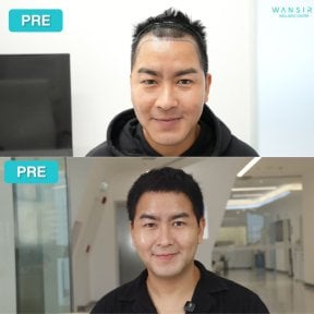 Before and after FUE hair transplant results at Wansiri Hospital, improved hairline and density