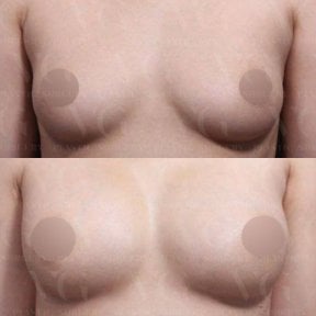 Vorher-nachher Brustvergrößerung mit Eigenfett bei VG Plastic Surgery, natürliches Ergebnis