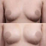 Vorher-nachher Brustvergrößerung mit Eigenfett bei VG Plastic Surgery, natürliches Ergebnis