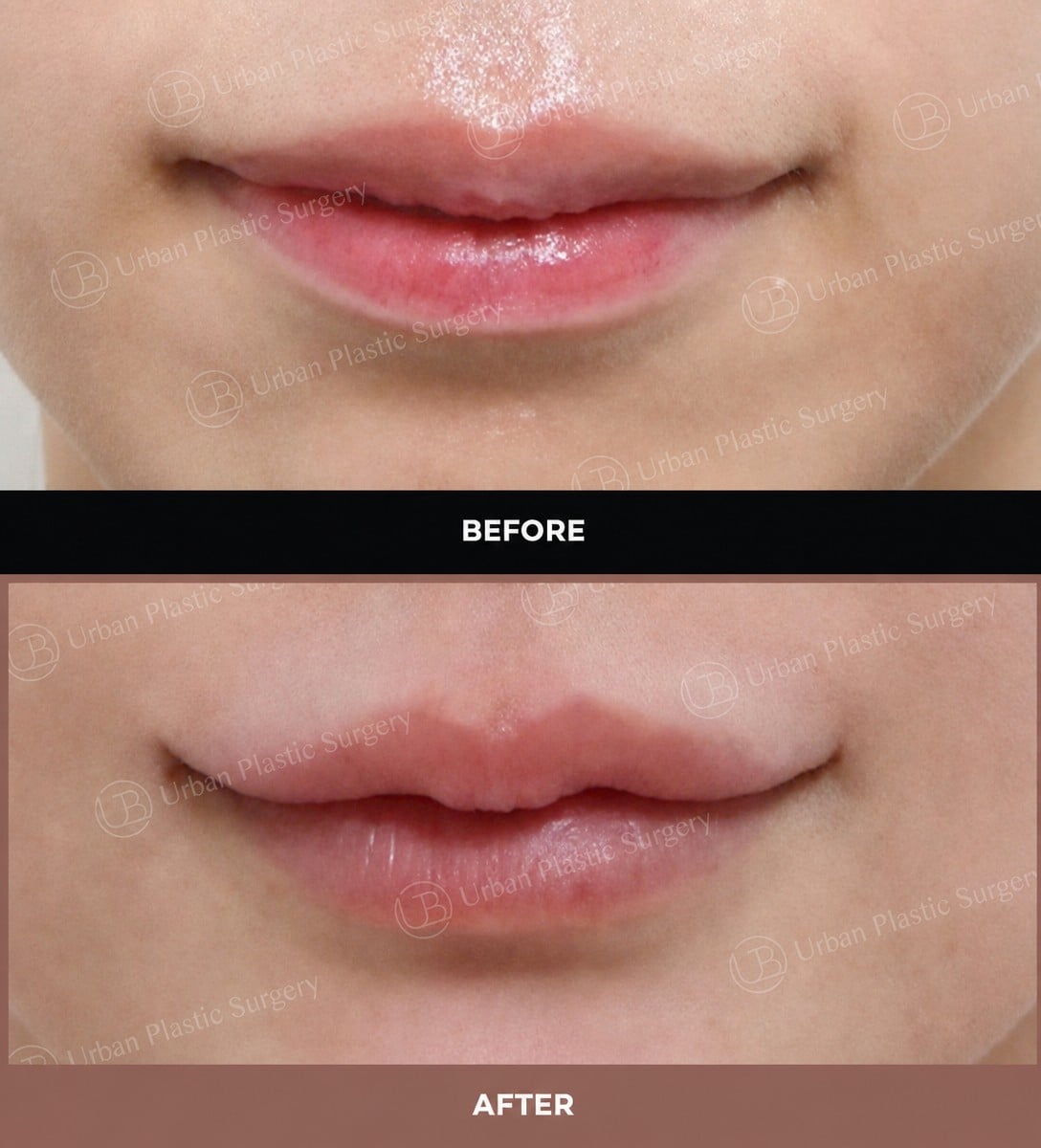 نتائج قبل وبعد رفع الشفاه في URBAN Plastic Surgery – تحسين شكل الشفة العليا