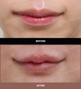 نتائج قبل وبعد رفع الشفاه في URBAN Plastic Surgery – تحسين شكل الشفة العليا