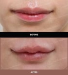 نتائج قبل وبعد رفع الشفاه في URBAN Plastic Surgery – تحسين شكل الشفة العليا