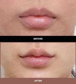 نتائج رفع الشفاه قبل وبعد في URBAN Plastic Surgery، تحسين شكل الشفة العليا