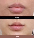 نتائج رفع الشفاه قبل وبعد في URBAN Plastic Surgery، تحسين شكل الشفة العليا