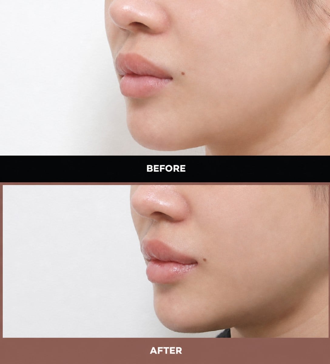 نتائج رفع الشفاه قبل وبعد في URBAN Plastic Surgery، تحسين شكل الشفاه