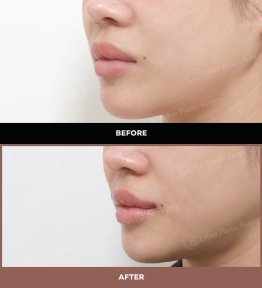 نتائج رفع الشفاه قبل وبعد في URBAN Plastic Surgery، تحسين شكل الشفاه