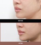 نتائج رفع الشفاه قبل وبعد في URBAN Plastic Surgery، تحسين شكل الشفاه