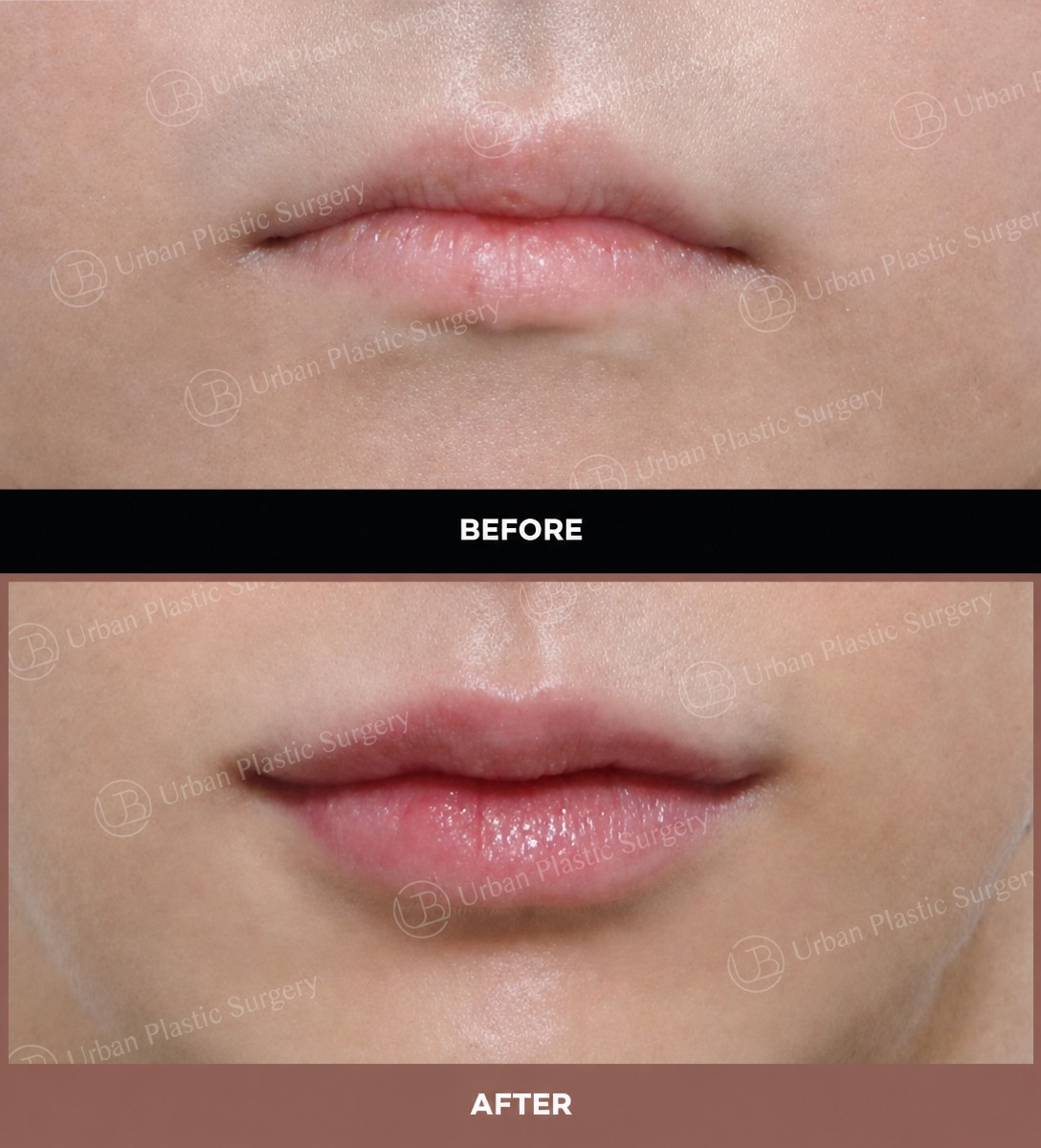 Resultados de lip lift antes y después en URBAN Plastic Surgery, contorno de labios mejorado