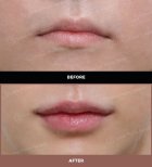 نتائج رفع الشفاه قبل وبعد في URBAN Plastic Surgery، تحسين شكل الشفاه