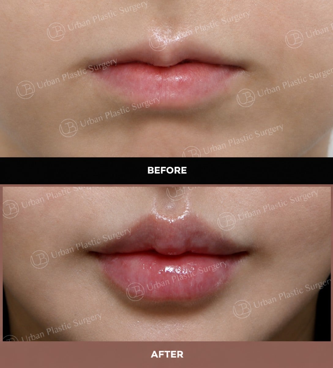 نتائج قبل وبعد رفع الشفاه في URBAN Plastic Surgery – تحسين شكل وحجم الشفاه
