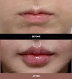 نتائج قبل وبعد رفع الشفاه في URBAN Plastic Surgery – تحسين شكل وحجم الشفاه