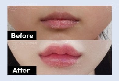 نتائج رفع الشفاه قبل وبعد في URBAN Plastic Surgery – تحسين شكل الشفاه وتحديدها