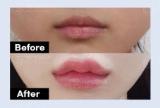 نتائج رفع الشفاه قبل وبعد في URBAN Plastic Surgery – تحسين شكل الشفاه وتحديدها