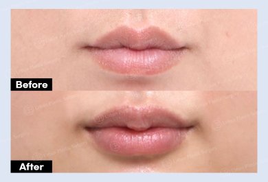 نتائج رفع الشفاه قبل وبعد في URBAN Plastic Surgery، تحسين شكل الشفة العليا