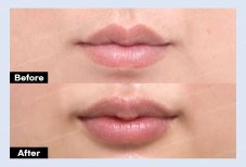نتائج رفع الشفاه قبل وبعد في URBAN Plastic Surgery، تحسين شكل الشفة العليا