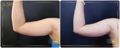Before and after Vaser liposuction arm contouring results at Asia Cosmetic Hospital