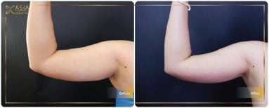 Before and after Vaser liposuction arm contouring results at Asia Cosmetic Hospital
