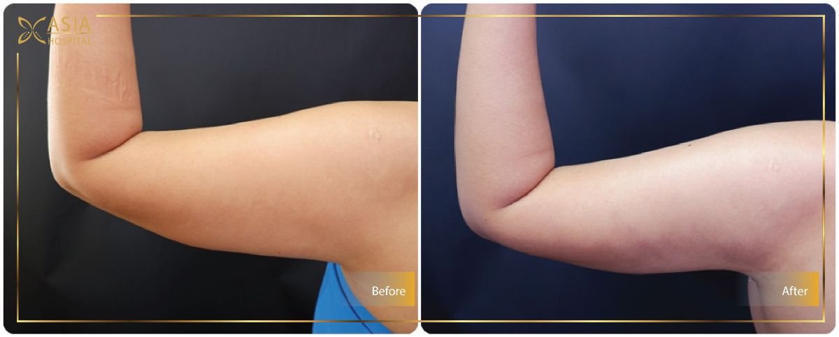 نتائج شفط الدهون بالفيزر للذراعين قبل وبعد في Asia Cosmetic Hospital، تحسين الشكل