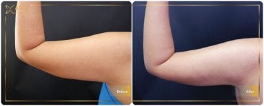 Before and after Vaser liposuction results on arms at Asia Cosmetic Hospital, improved contour