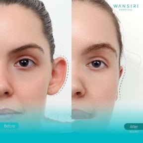 Before and after otoplasty results at Wansiri Hospital, ear reshaping with natural appearance