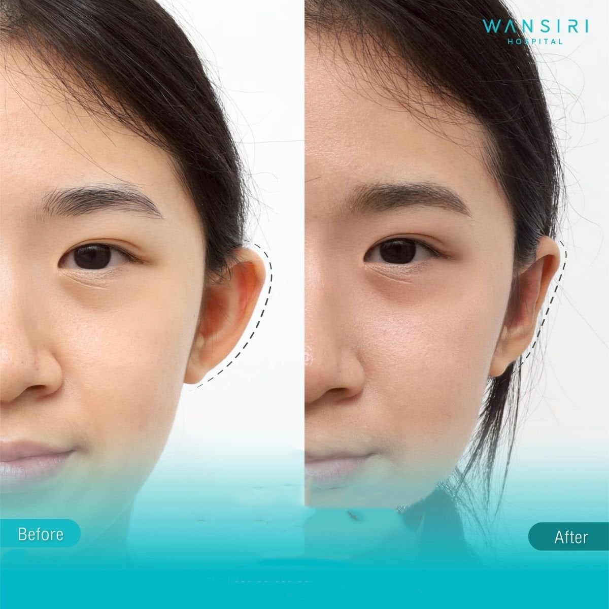 Resultados de otoplastia antes y después en Wansiri Hospital, mejora de forma de orejas
