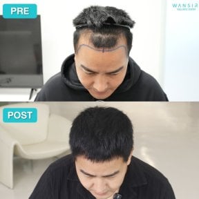Before and after FUE hair transplant results at Wansiri Hospital, restored hairline in male patient