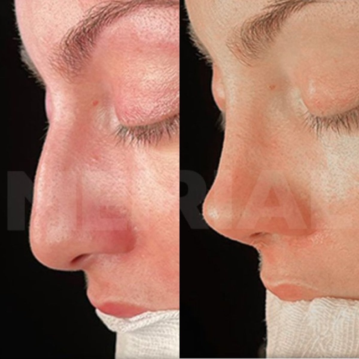 Resultado antes y después de rinoplastia ultrasónica en Memorial Bahçelievler Hospital, remodelación nasal