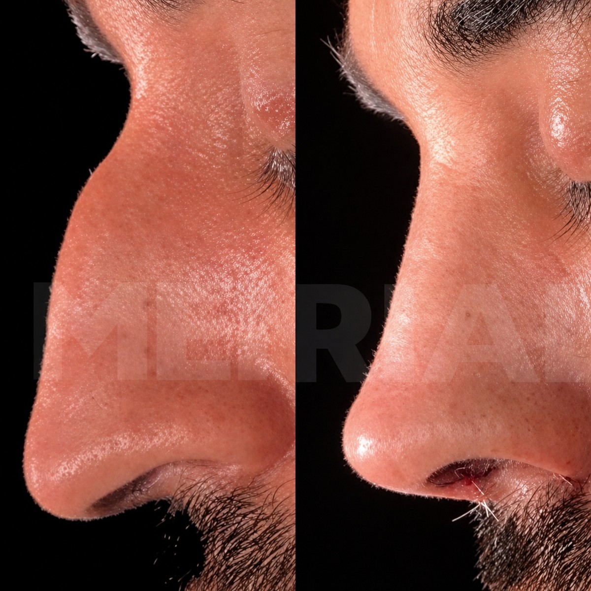 Resultados antes y después de rinoplastia ultrasónica en Memorial Bahçelievler Hospital